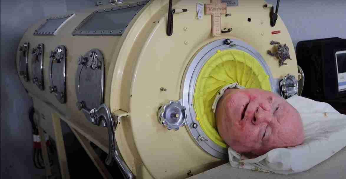 Iron lung man Paul Alexander, who lived inside an iron lung for more than 70 years, dies at 78