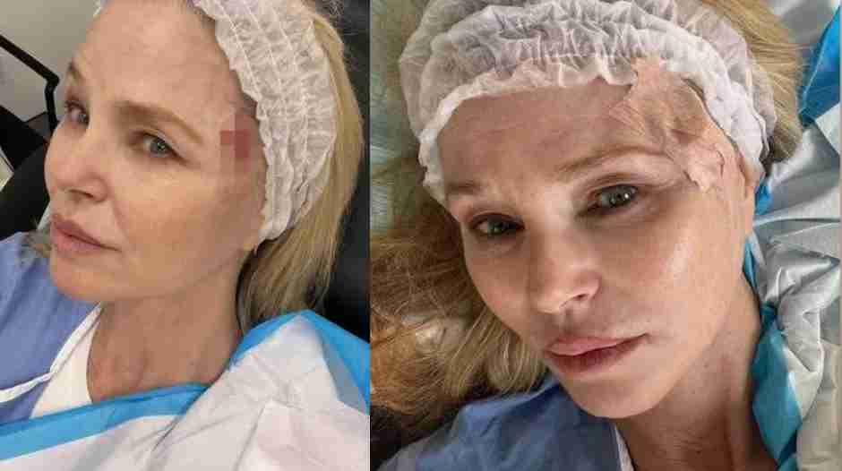 Christie Brinkley Opens Up About Her Skin Cancer Journey Through Post-Surgery Selfies